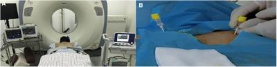 Comparative study of CT-guided radiofrequency and alcohol ablation in the treatment of primary hyperhidrosis